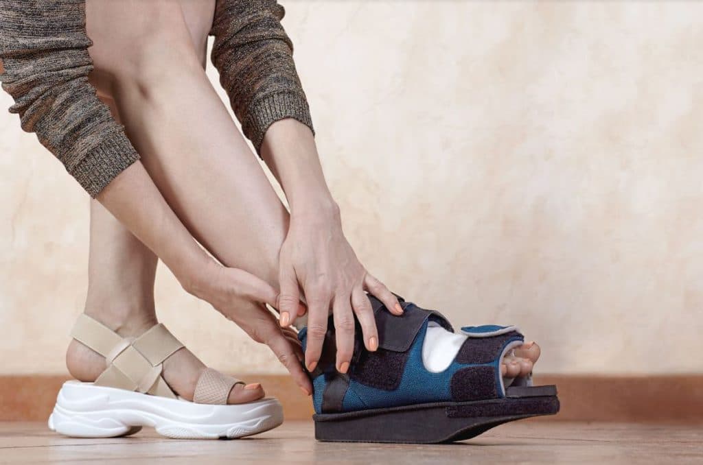 Bunion Surgery Recovery: A Realistic Timeline